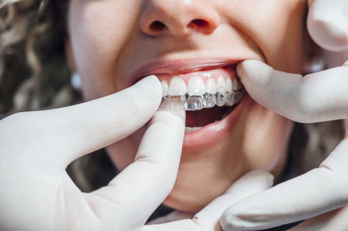 dentiste posant des gouttières d'alignement